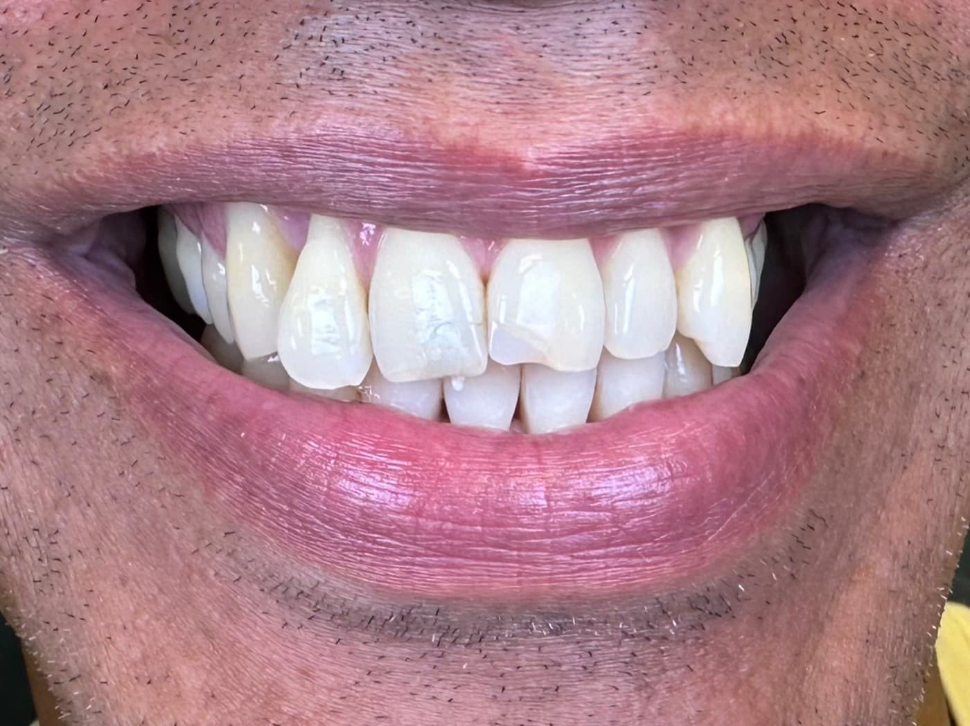 Case 04, before treatment